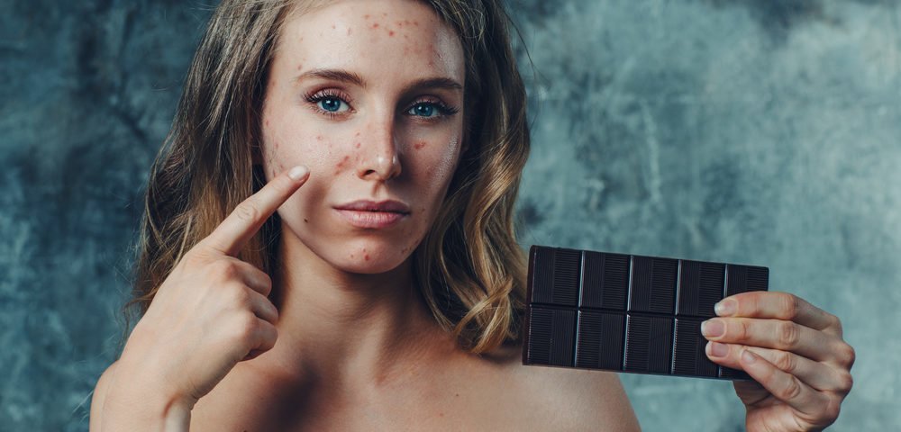 simple connection acne diet